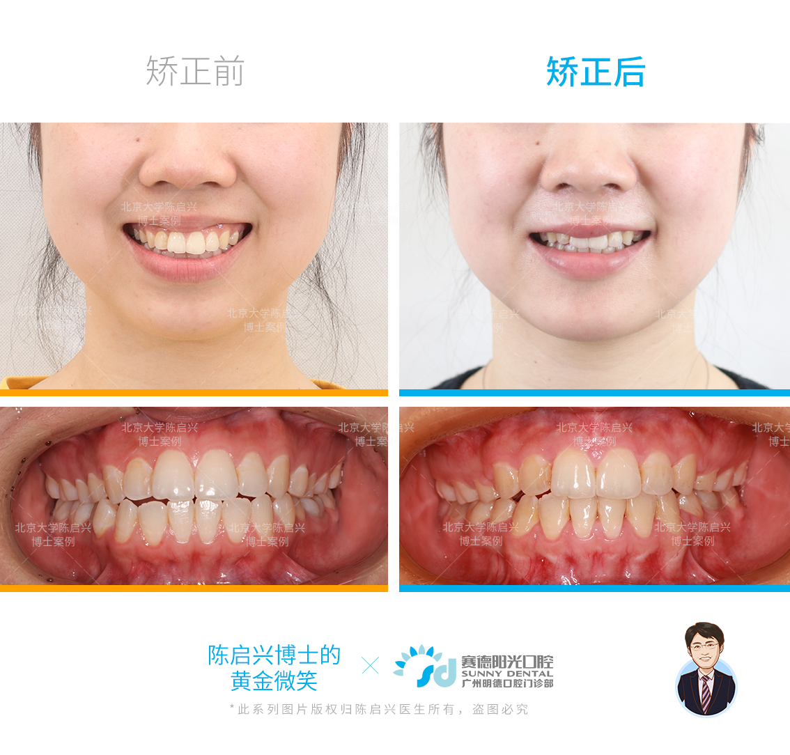 并且由于女生上颌腭盖高拱,上下牙弓宽度不匹配,上牙弓