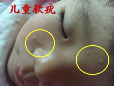 轻松治疗儿童传染性软疣!--皮肤病无痛治疗系列(1)-纪秀军主任医师-爱