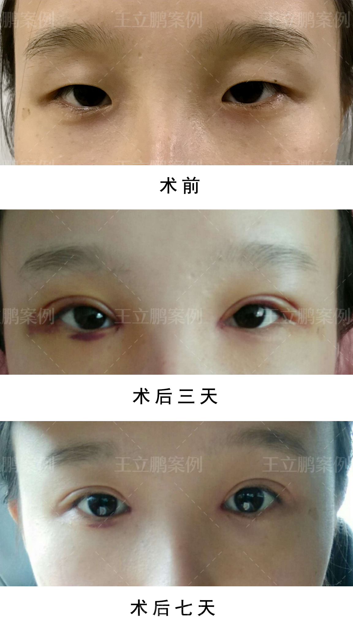 割完双眼皮如何避免疤痕增生?术后护理很重要!
