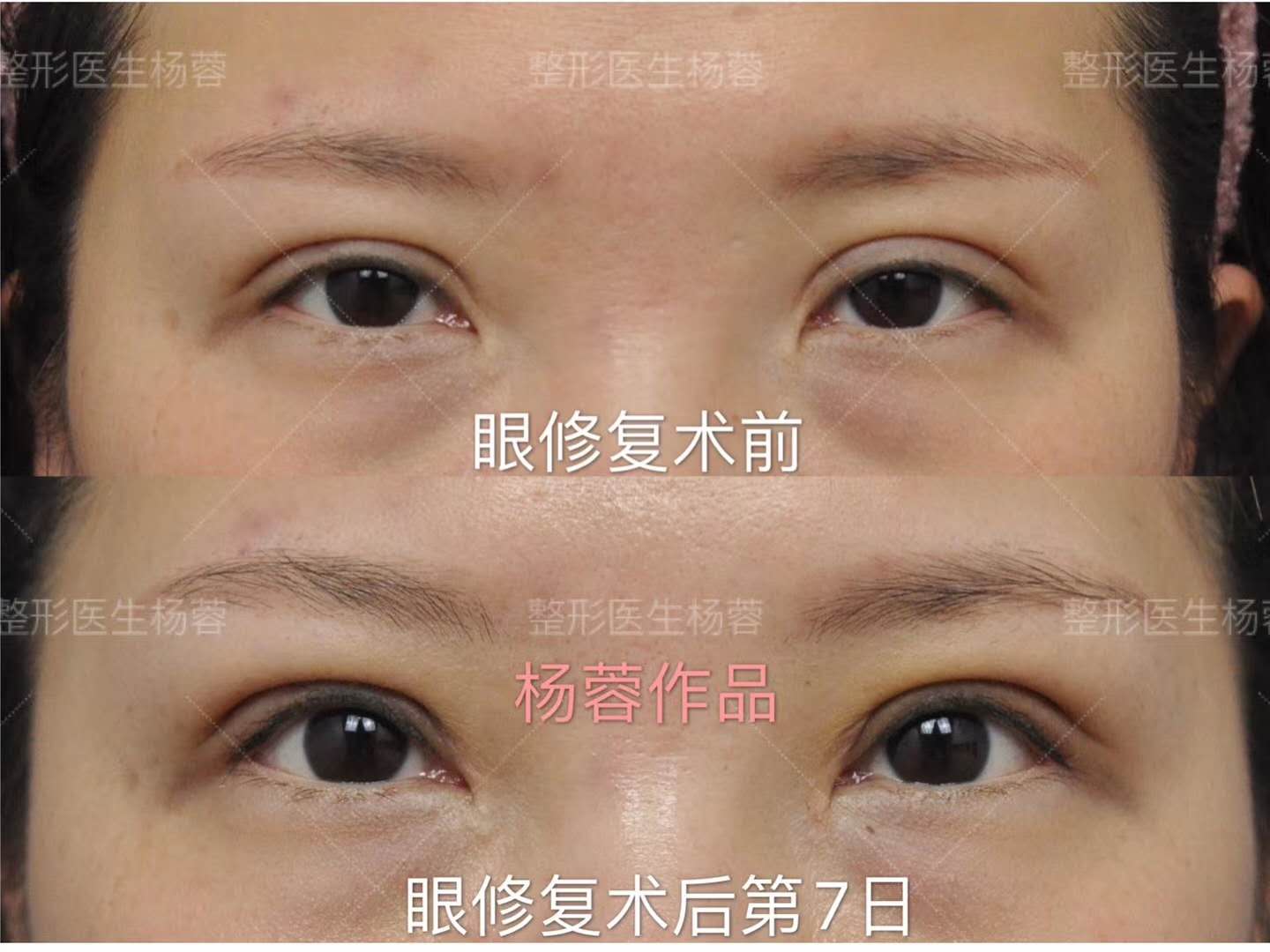 内眼角修复案例：开内眼角后出现了豁口、圆钝、疤痕怎么办？通过解剖复位还原初眼状态 - 知乎