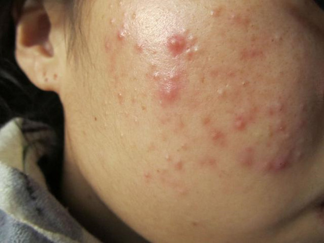 治疗痤疮(青春痘)常用的西药有哪些?