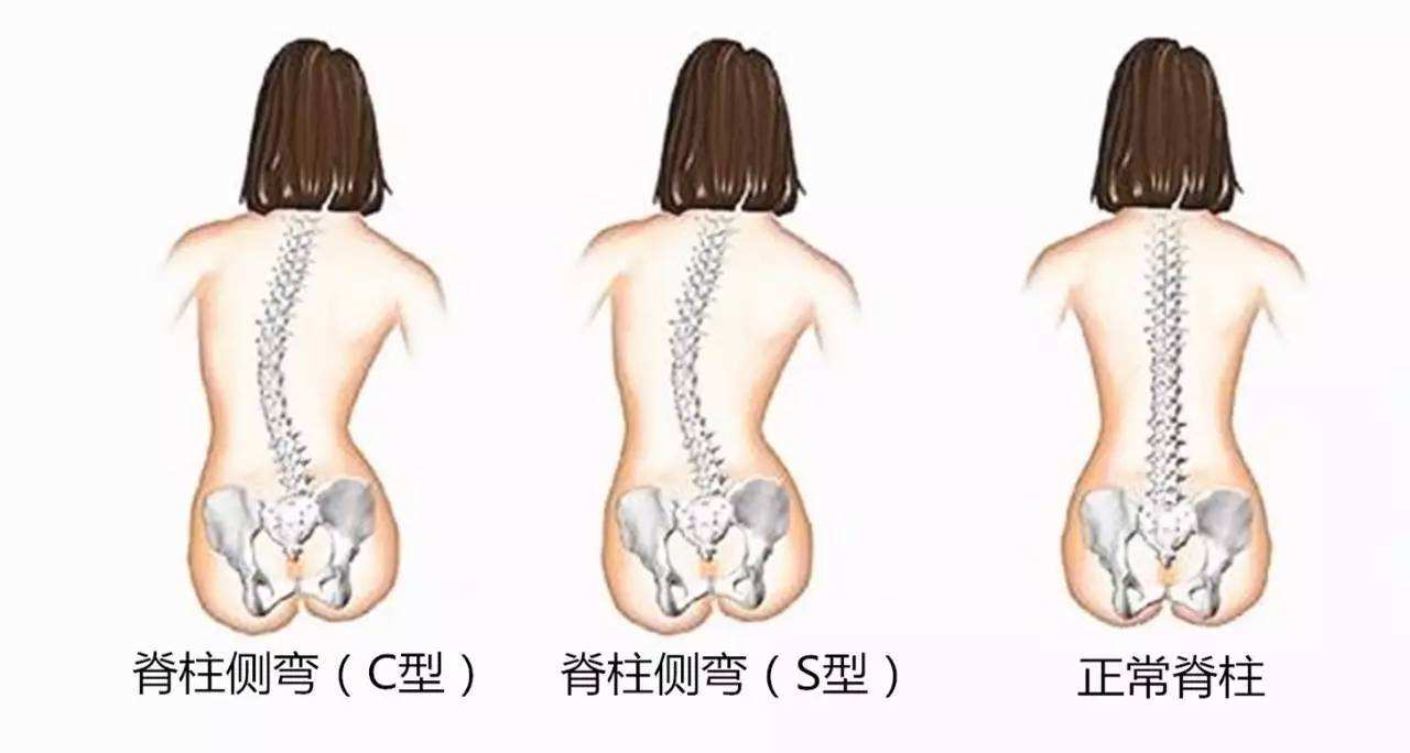 腰部脊椎侧弯图片