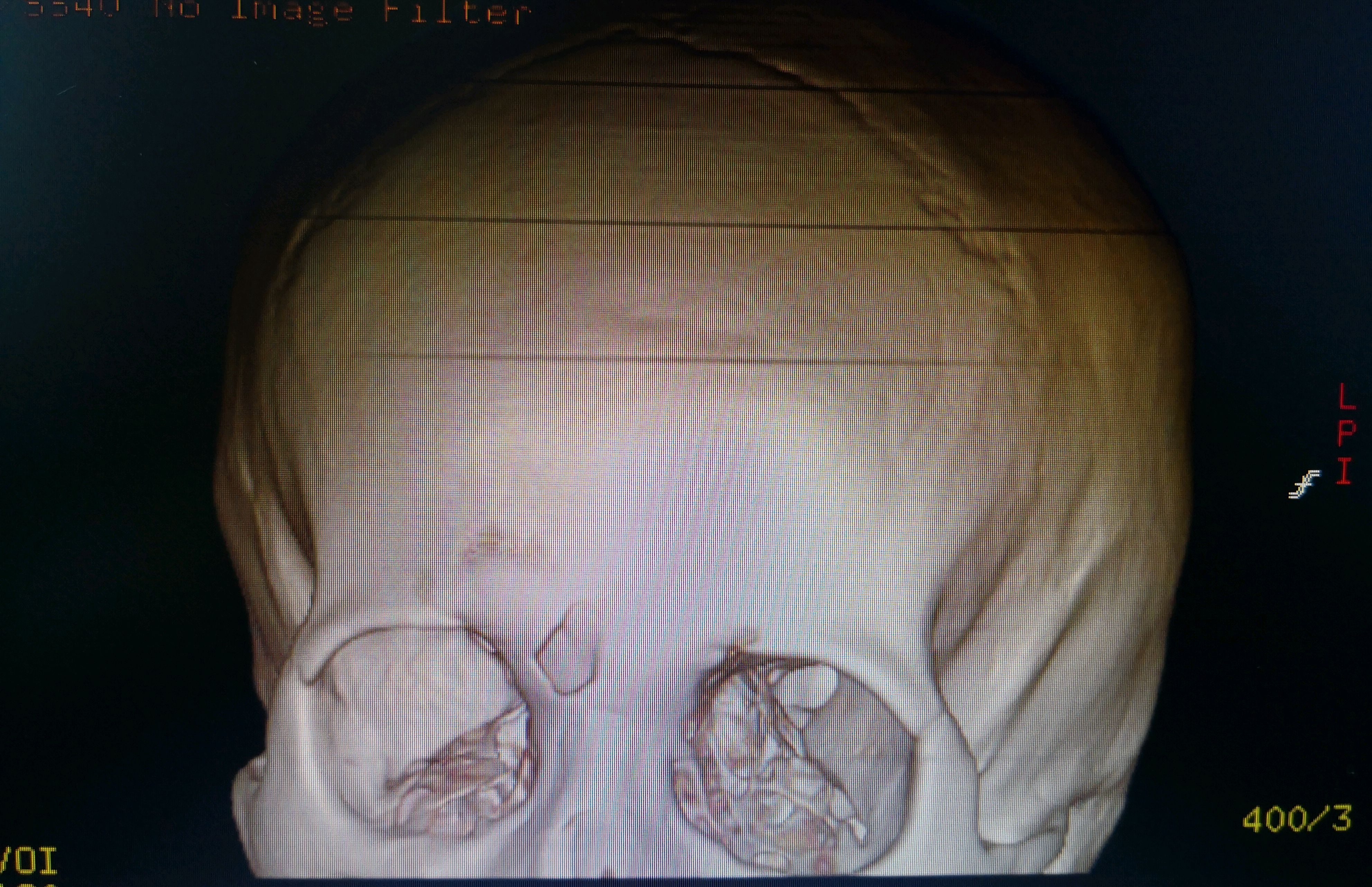颅骨骨折x线图片图片