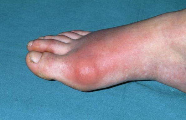 医生提醒:手脚出现这2种症状,可能你的尿酸已经高了很久了