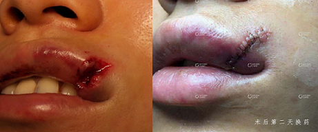唇粘膜伤口都需要缝合吗