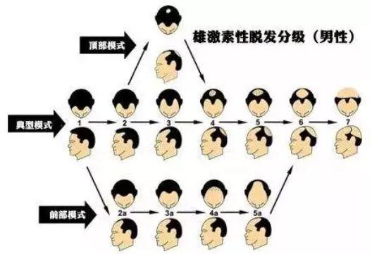 烦人的雄性激素脱发问题,到底要怎么解决?