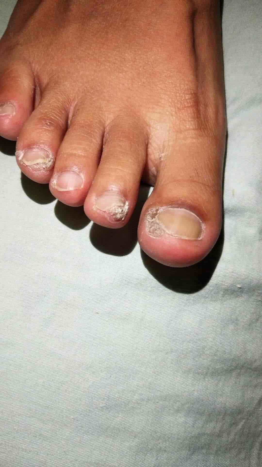 甲周疣虽发生于甲缘 ,其根部常位于甲廓内 ,偶有向甲下蔓延 , 所以