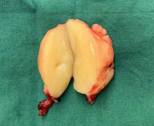 年轻女孩肋骨间发现肿瘤,三公分小切口,保住了胸部美观