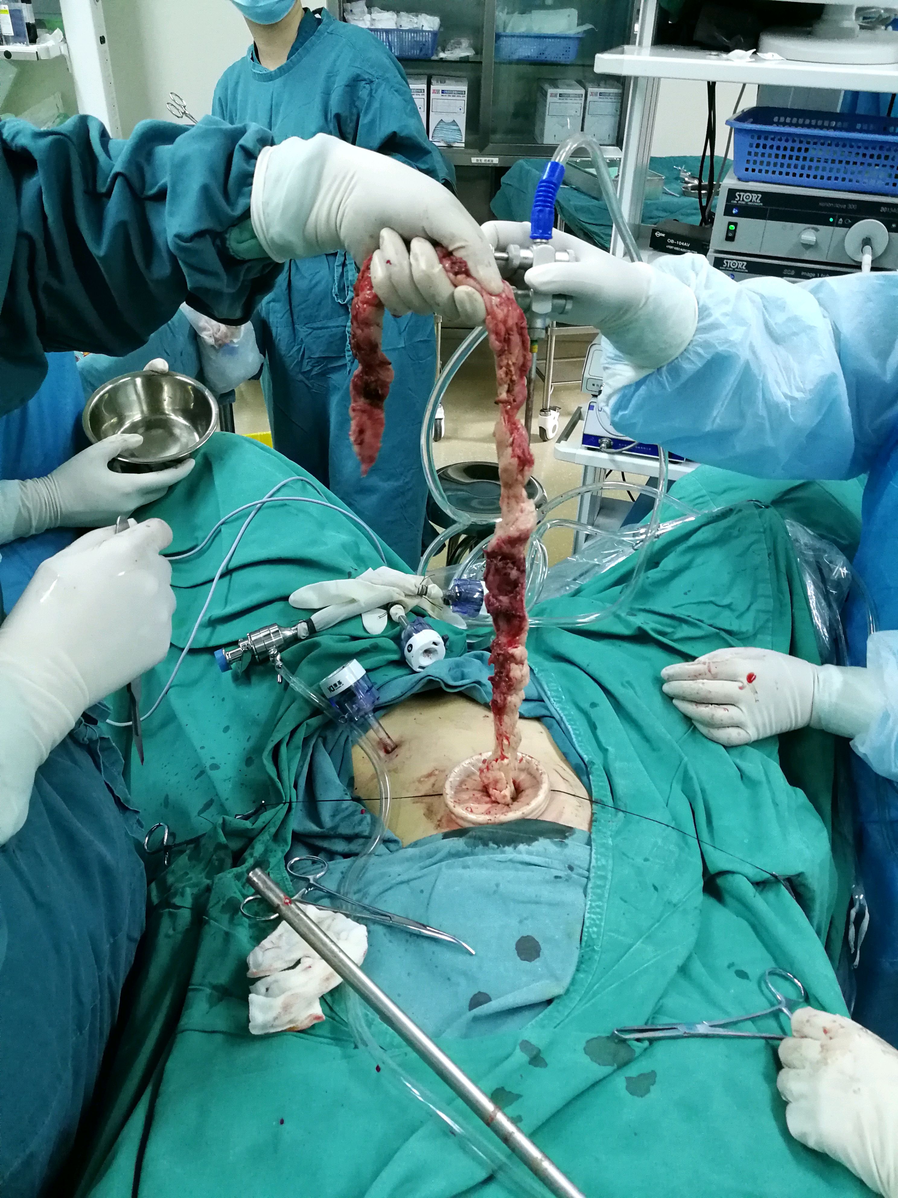 7经脐单孔腹腔镜手术是一种新术式吗?