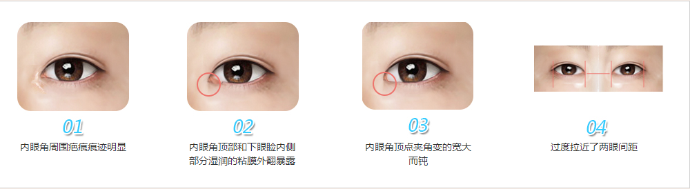【内眼角修复】哪什么来拯救"失败"的双眼皮