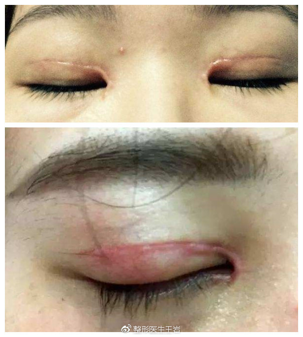 为什么双眼皮术后会出现疤痕增生