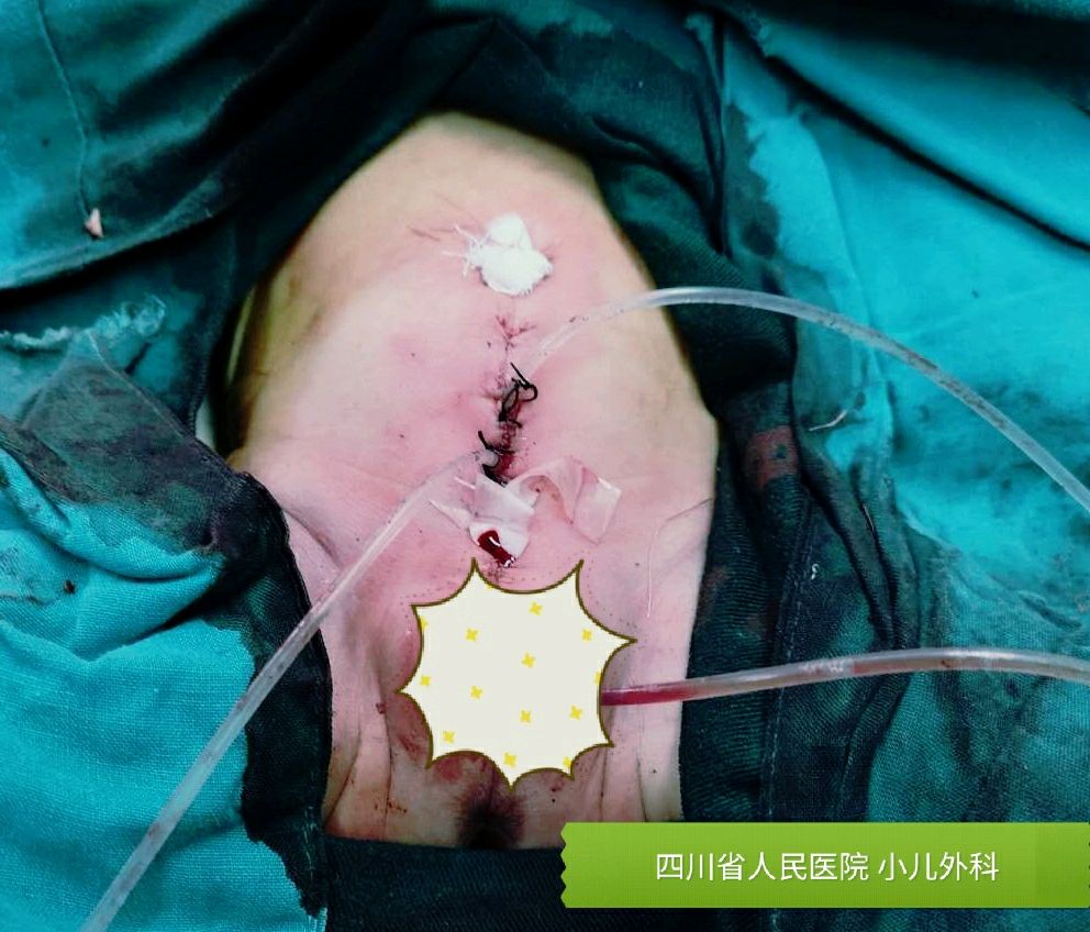 得了膀胱外翻这种罕见病你是不幸的,但幸运的是,你的爸爸妈妈对你不离