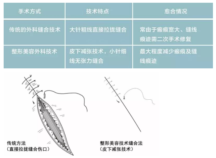 根部袖套式环切术图片