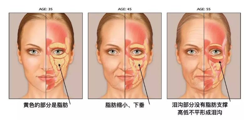 未老先衰的三八紋