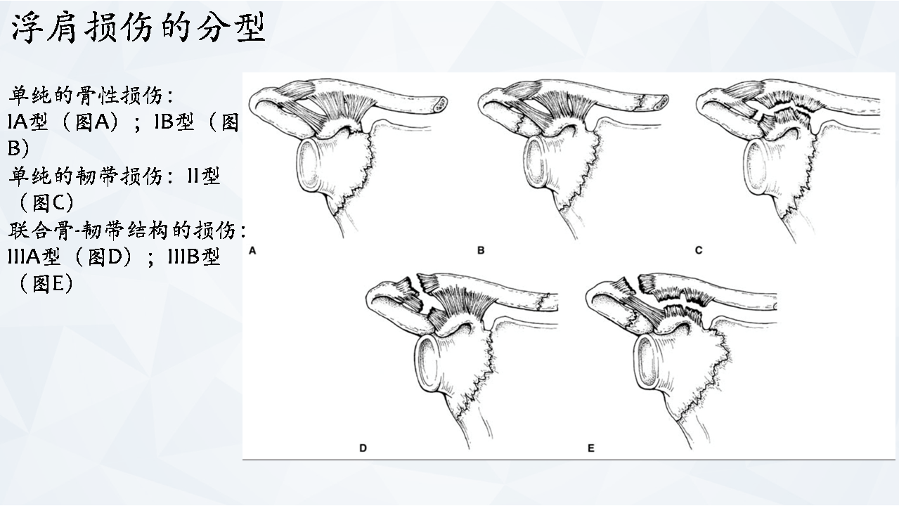 涨知识肩胛骨骨折分型