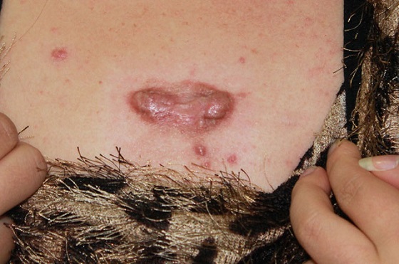 瘢痕疙瘩不管不顾有什么危害?