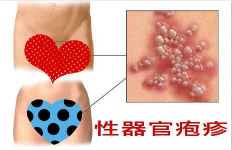 女性轻微疱疹感染图片图片