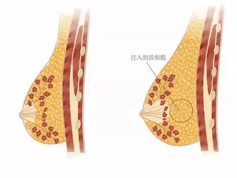 科普贴丨自体脂肪隆胸——改变你的胸