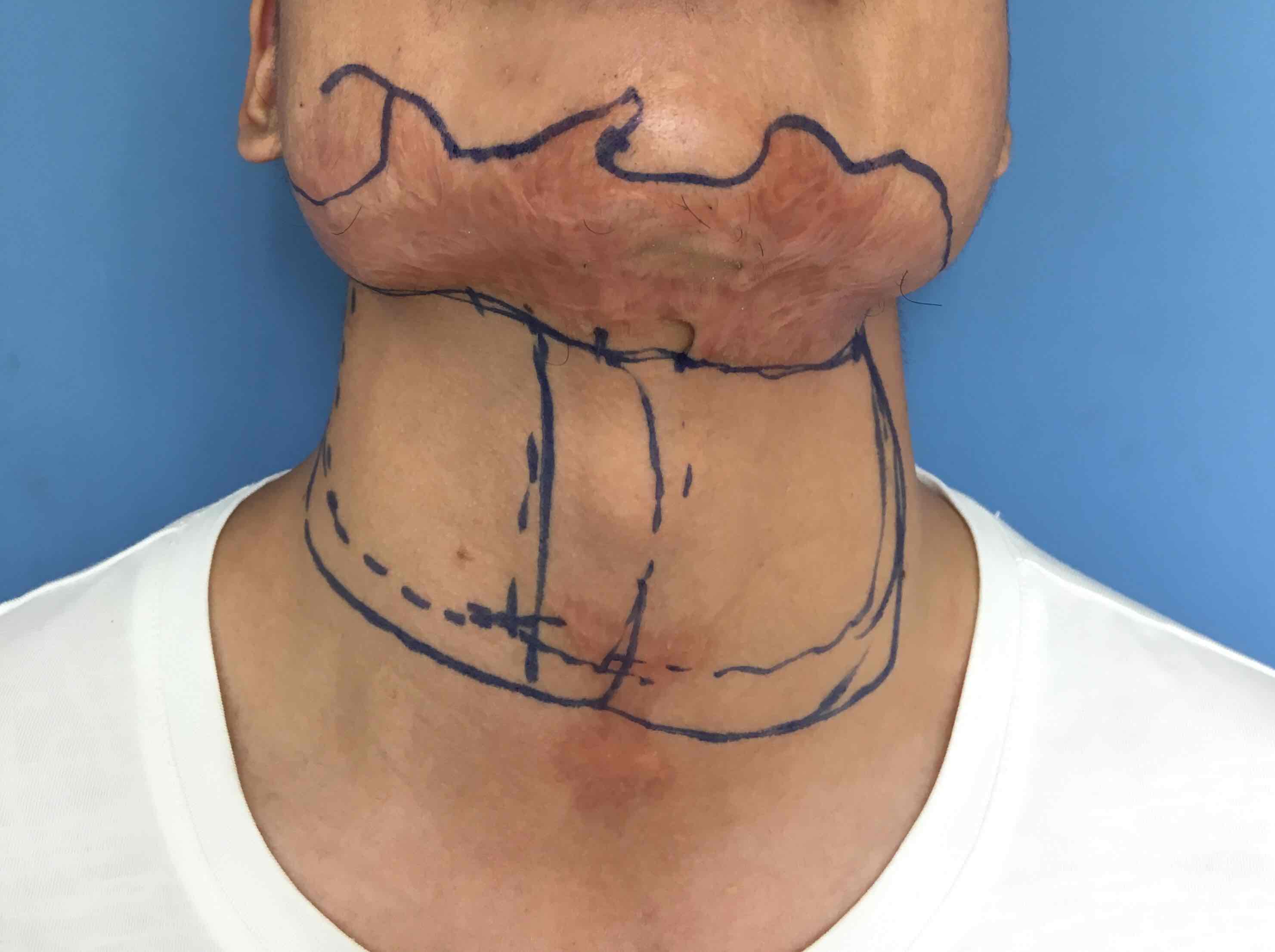 颈部疤痕扩张器效果图片