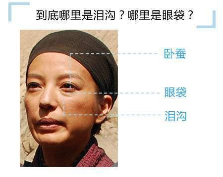 泪沟到底是怎么回事?