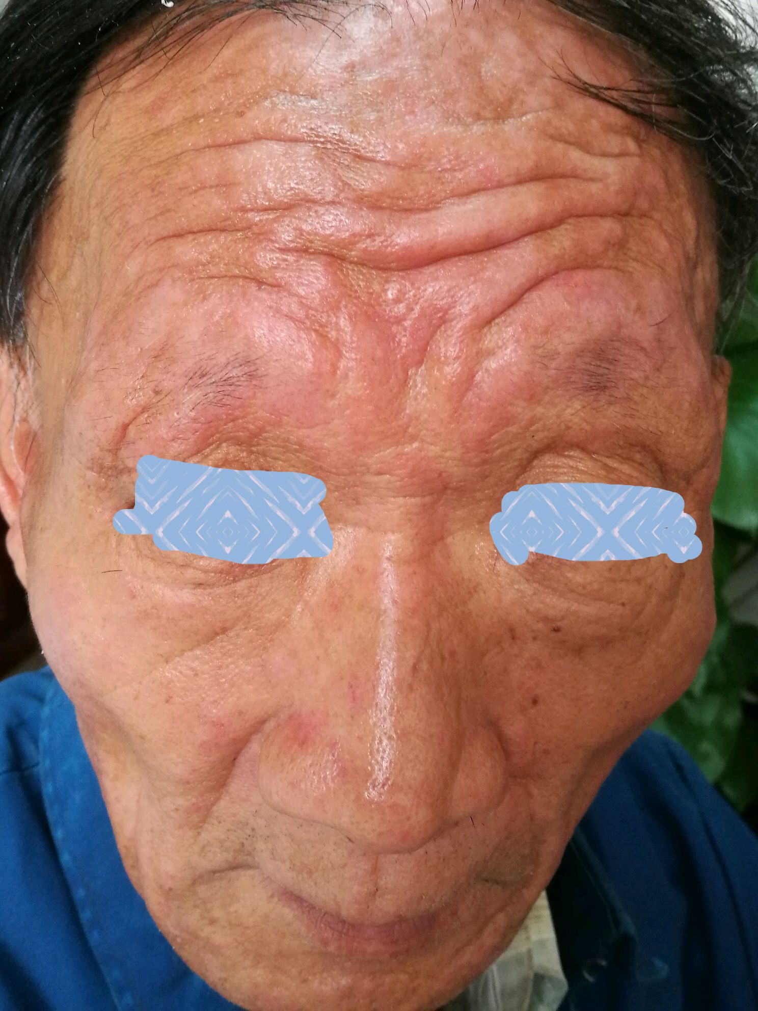 慢性光化性皮炎