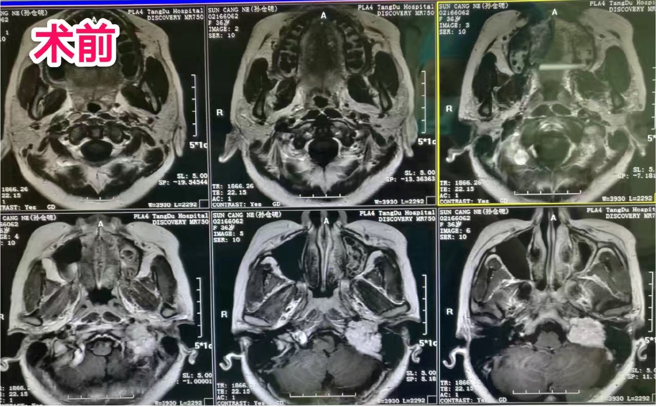 经岩迷路下入路切除颈静脉球瘤手术病理命名:鼓室球瘤,颈静脉球体瘤