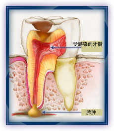 齿质(牙本质)是位于牙釉质下面较为柔软的一层物质.