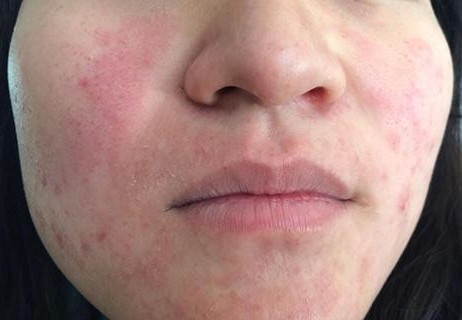 春季常见皮肤问题?该怎么解决?