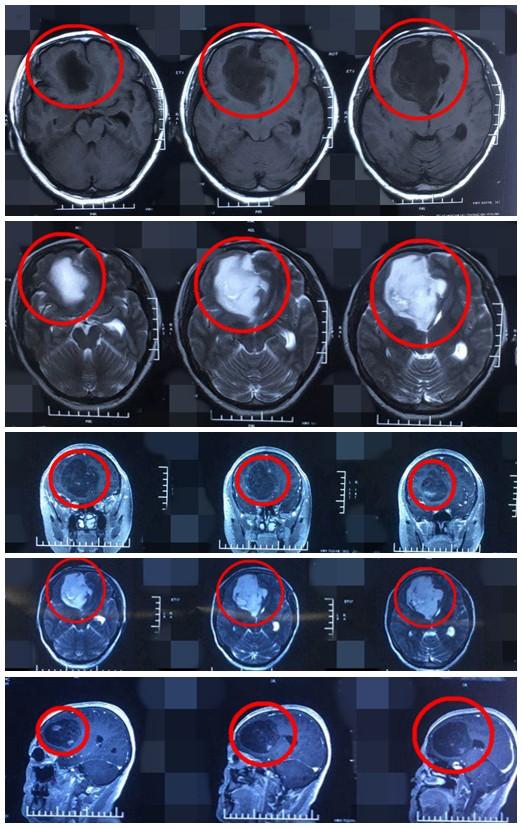 头疼十年原来是长了恶性脑肿瘤显微镜下手术全切还患者健康