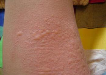 皮肤出现以下症状可要当心了