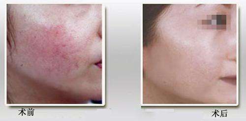 3,酒糟鼻,蜘蛛痣.两种特殊类型的红血丝,我们使用980