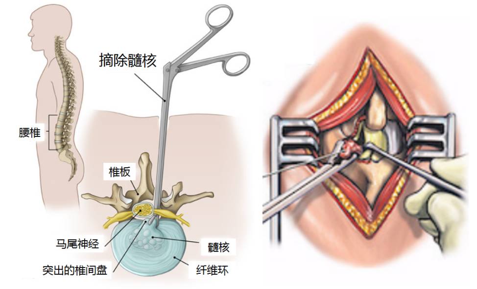 开放或显微内镜椎间盘摘除术开放椎间盘摘除术是脊柱外科医生最熟悉的
