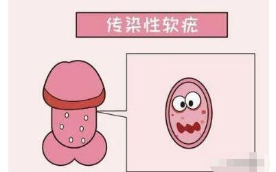 私处长了一个小肉芽不痛不痒是尖锐湿疣吗?