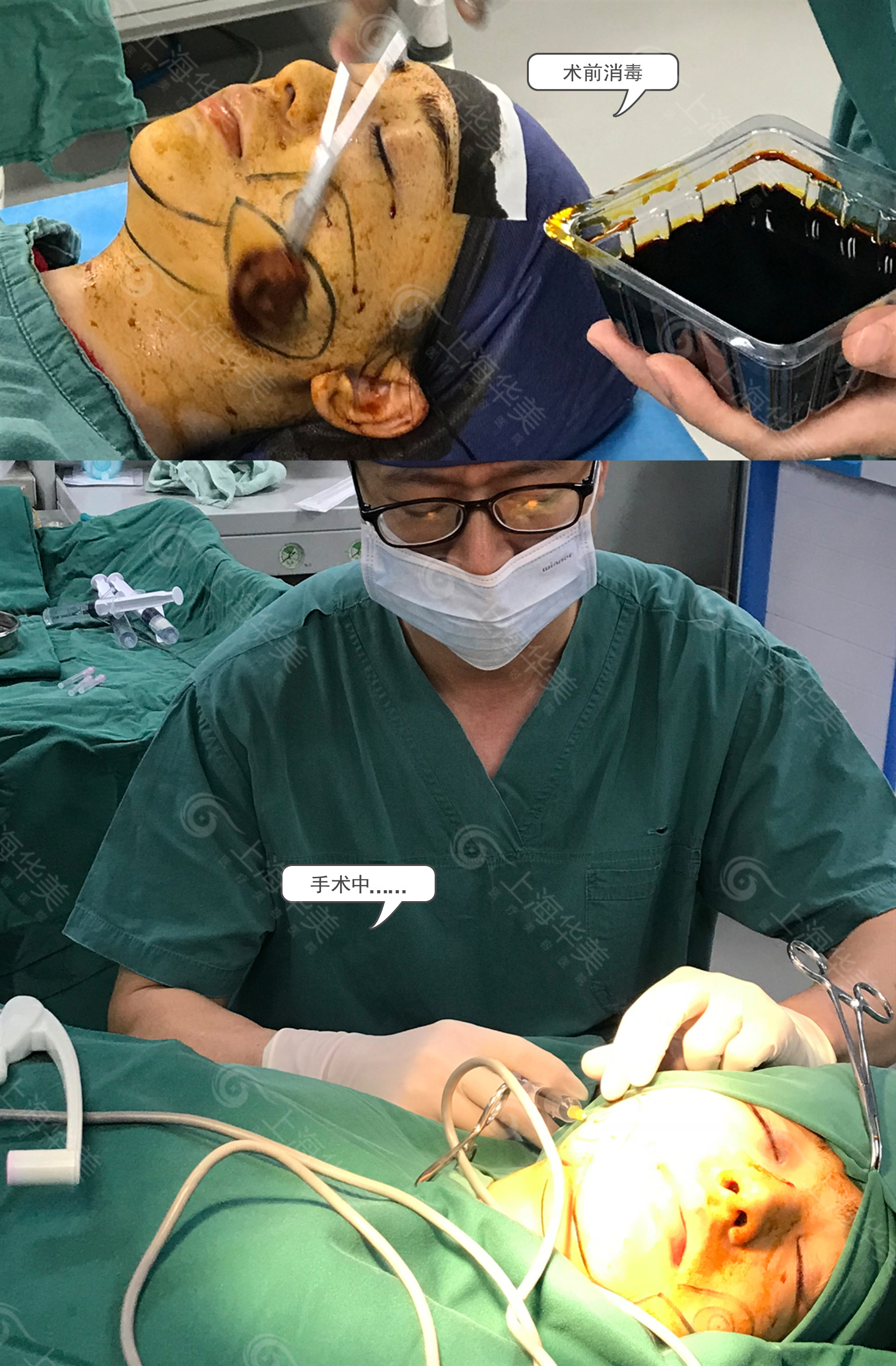 面部吸脂需要哪些流程