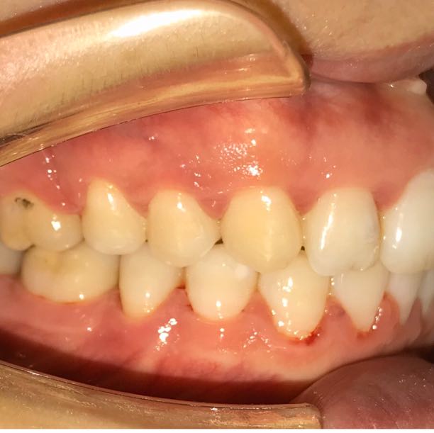 分享一例后牙双侧缺失,前牙内倾式深覆合的案例_章依文__爱问健康