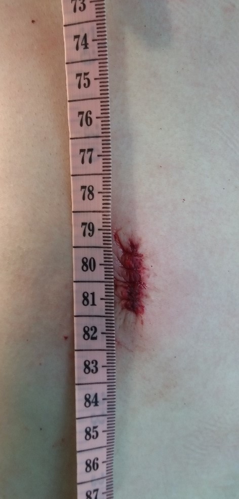 今天桶状胸"超微创"手术:无管,2cm微小切口,3条合金板