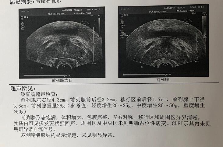 前列腺钙化彩超图片