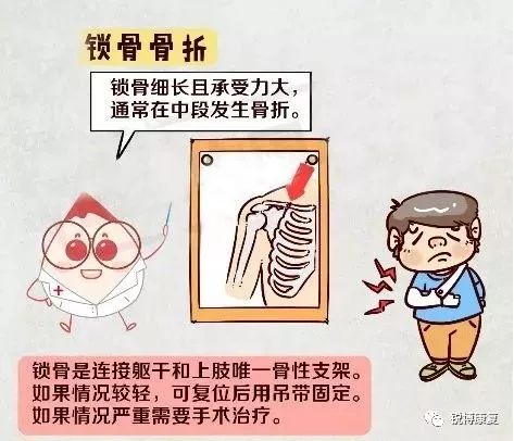 锁骨骨折后,我的胳膊还能动吗?