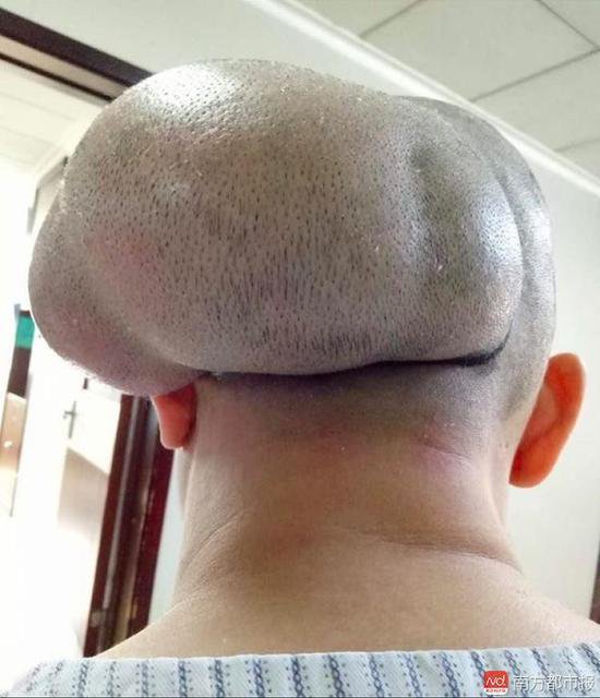 南都讯 头部带瘤三十多年未做处理,34岁庄小姐头部已然是"一个头两个