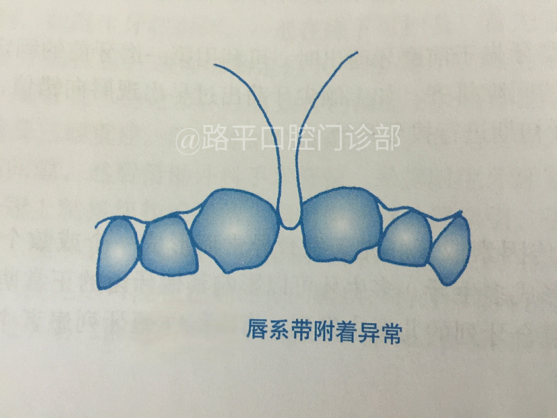 上唇系带过短的手术时机