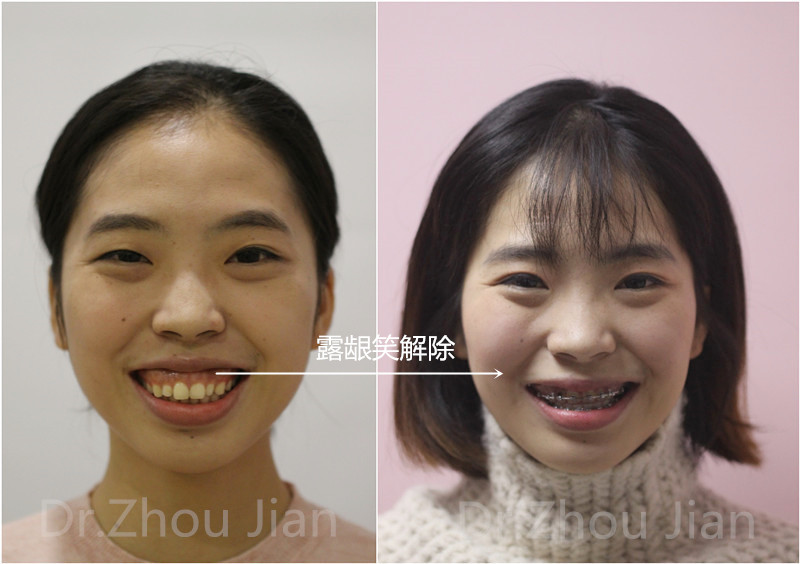 成人骨性前突告别手术,拔牙矫正加支抗钉美到你害怕!