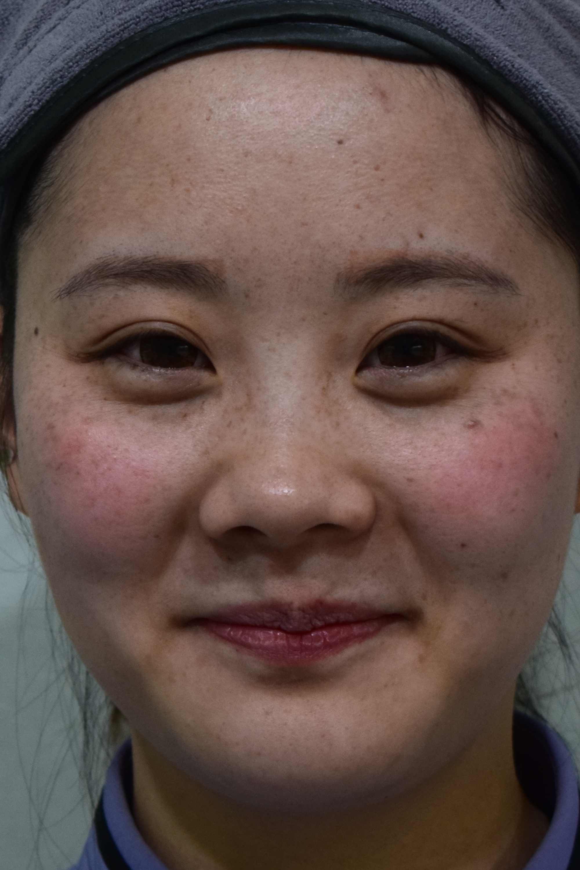 脉冲光治疗雀斑,红血丝,日晒斑