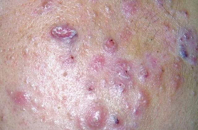 严重的炎症,同时会刺激皮肤下的成纤维细胞增生,造成结节样的组织形成