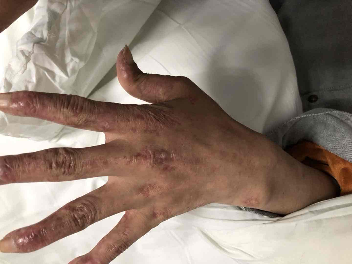 系统性红斑狼疮患者合并结核感染
