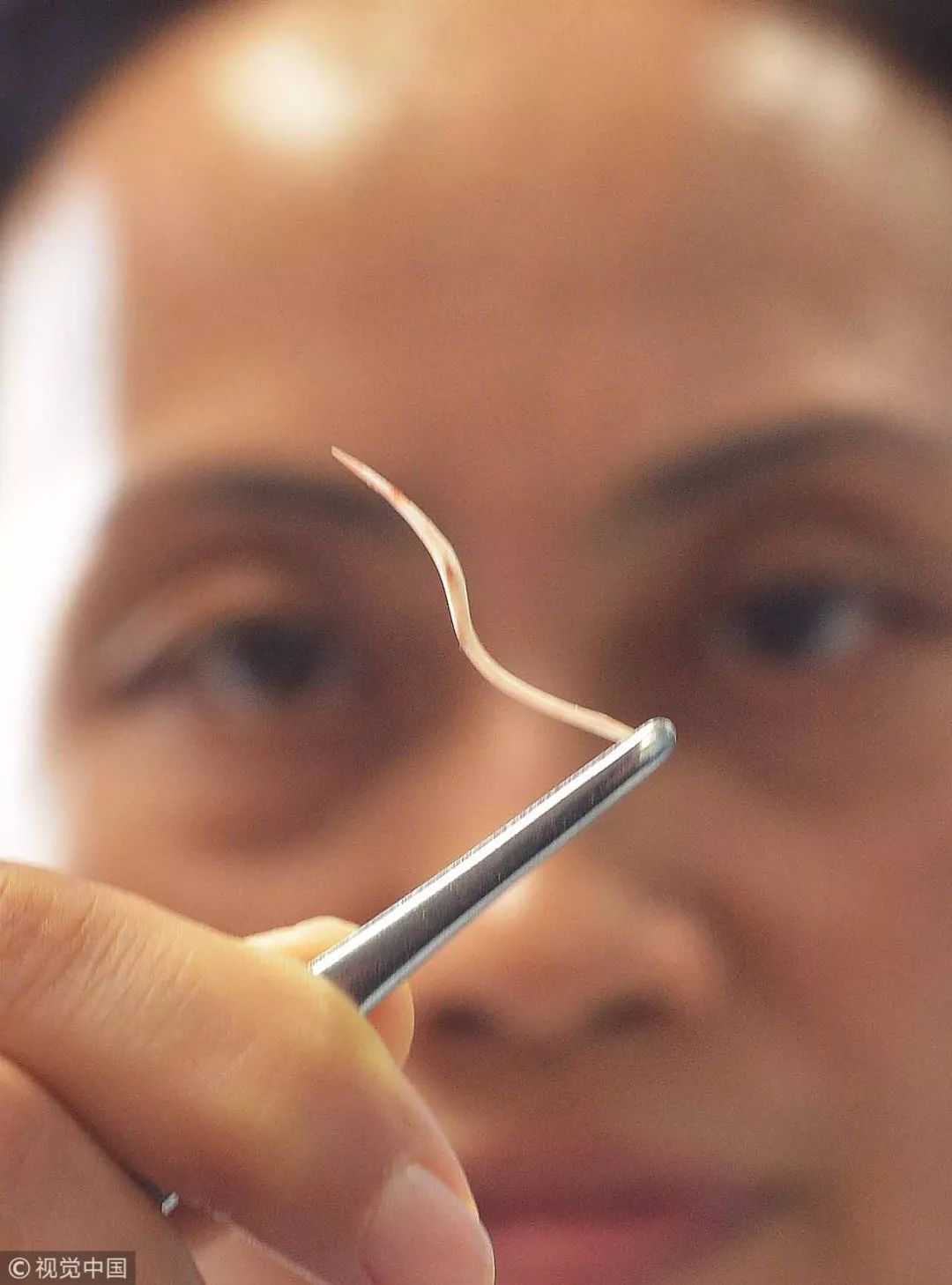 2013年11月19日,武汉市一名医生取出卡在患者身体里的鱼刺 | 视觉中国