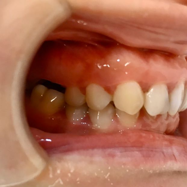 分享一例后牙双侧缺失,前牙内倾式深覆合的案例
