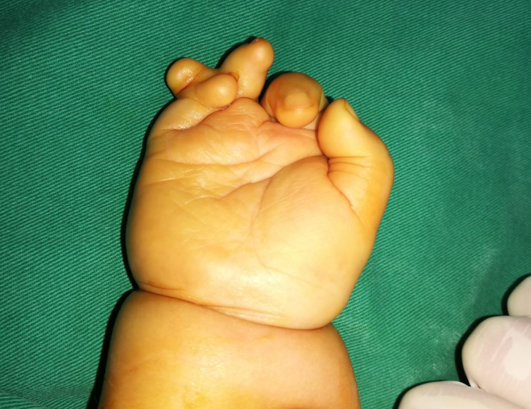 宝宝复杂并指治疗案例一