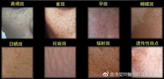 雀斑:雀斑,通常分布在日光容易照射到的区域.