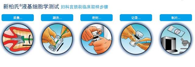 tct取样的过程图图片