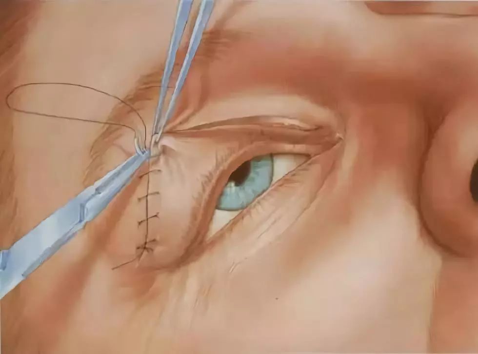 缝合通过"去皮,去脂",在做出双眼皮褶子的同时,解决眼皮松,肿问题,这